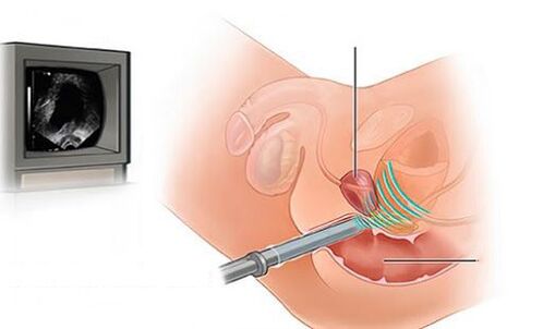 ultrasound sa prostate